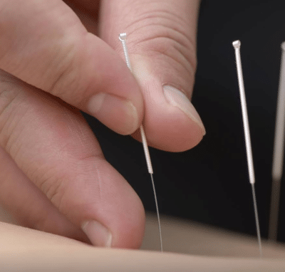 Wist u dat acupunctuur tegen oorsuizen werkt?